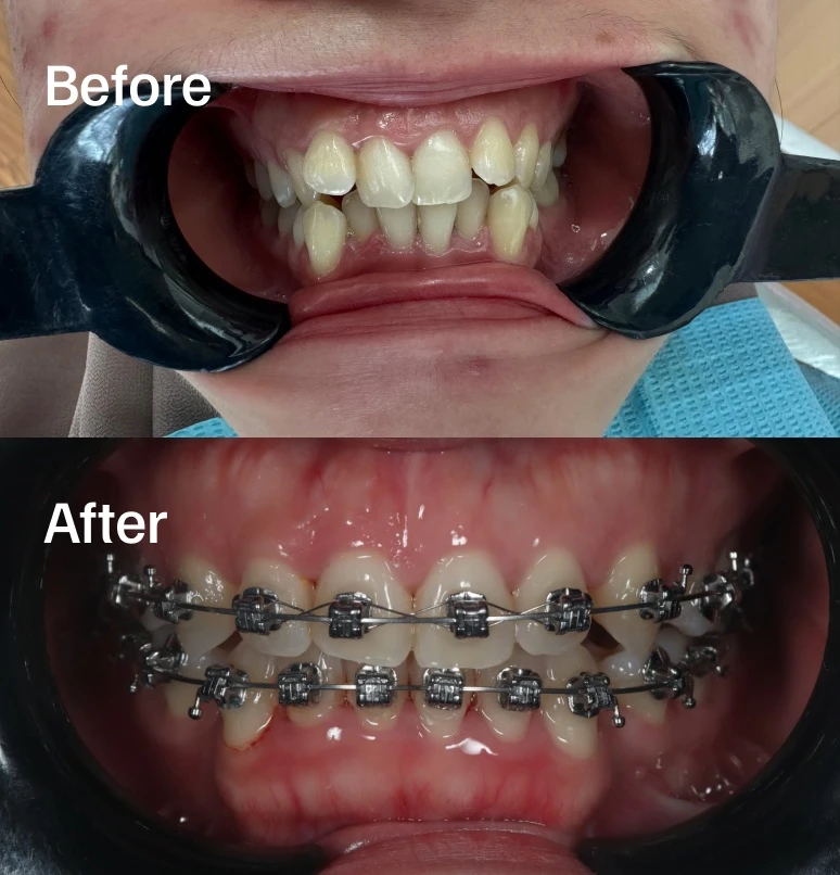 Before and after Damon braces
