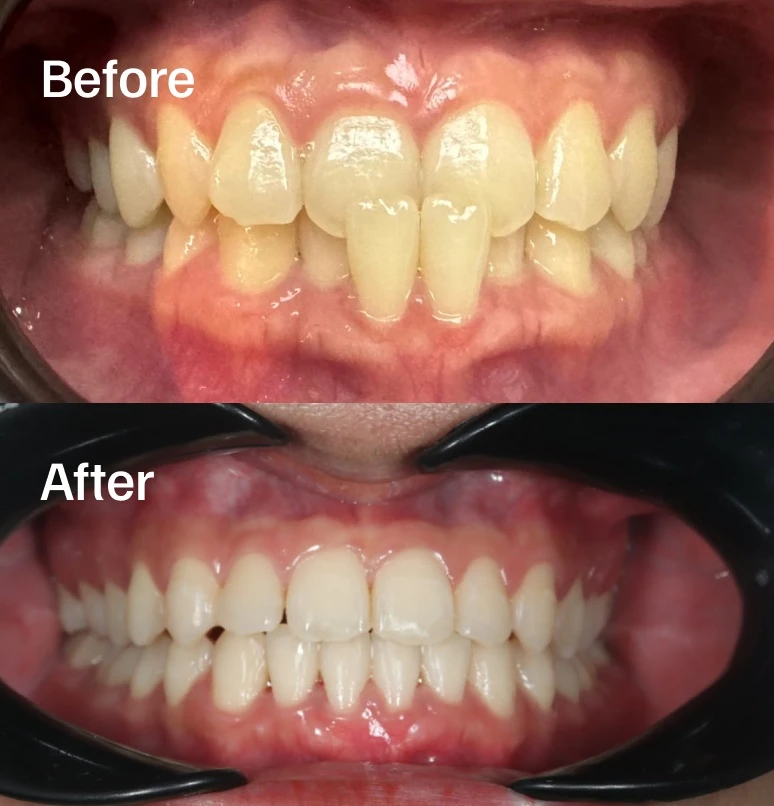 Before and after metal braces