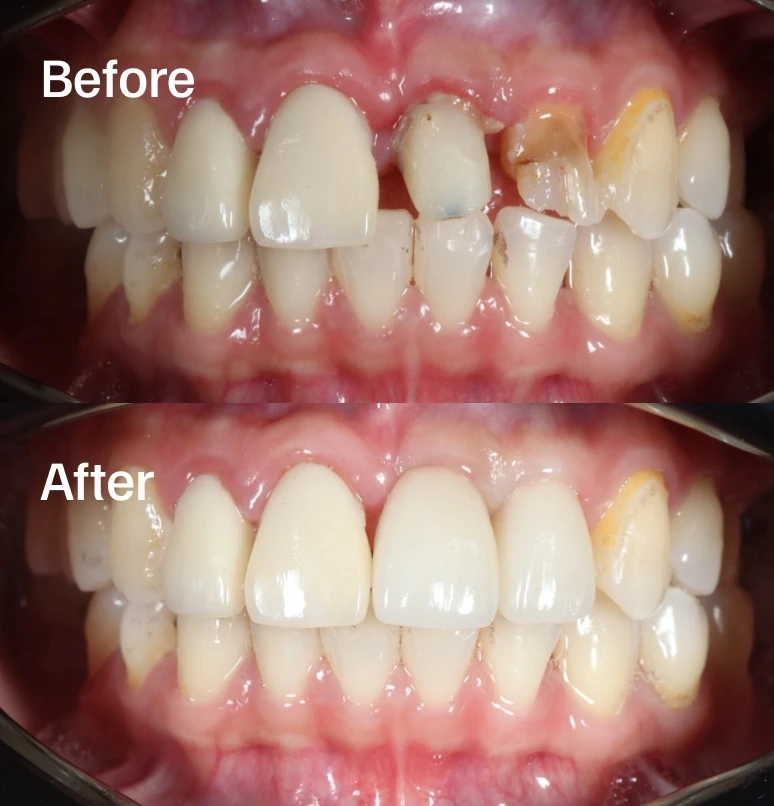 Before and after dental crown