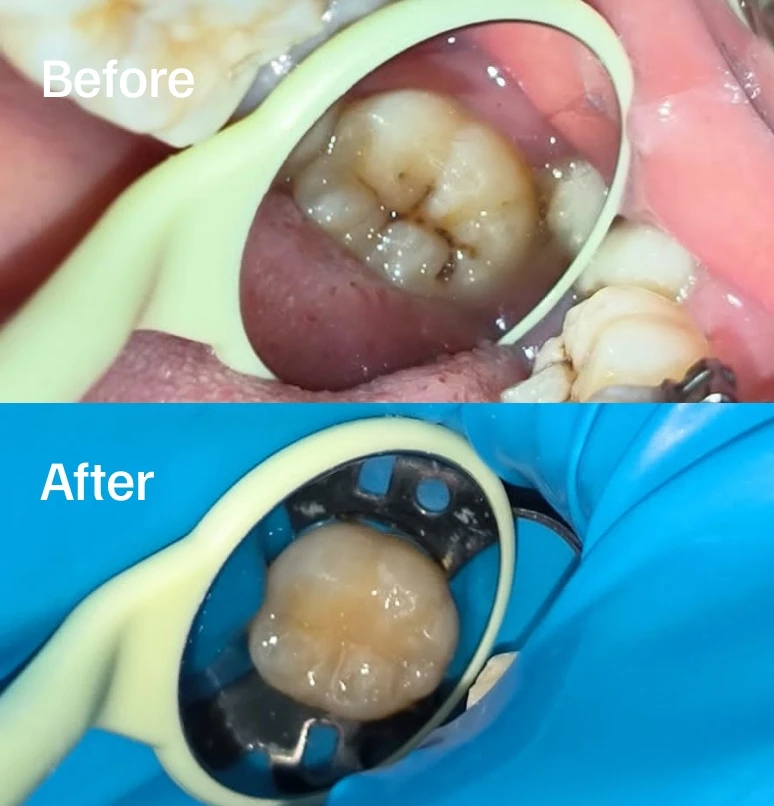 Before and after aesthetic filling