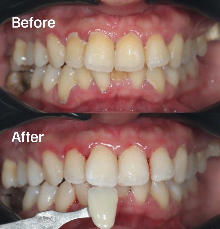 Before and after teeth bleaching