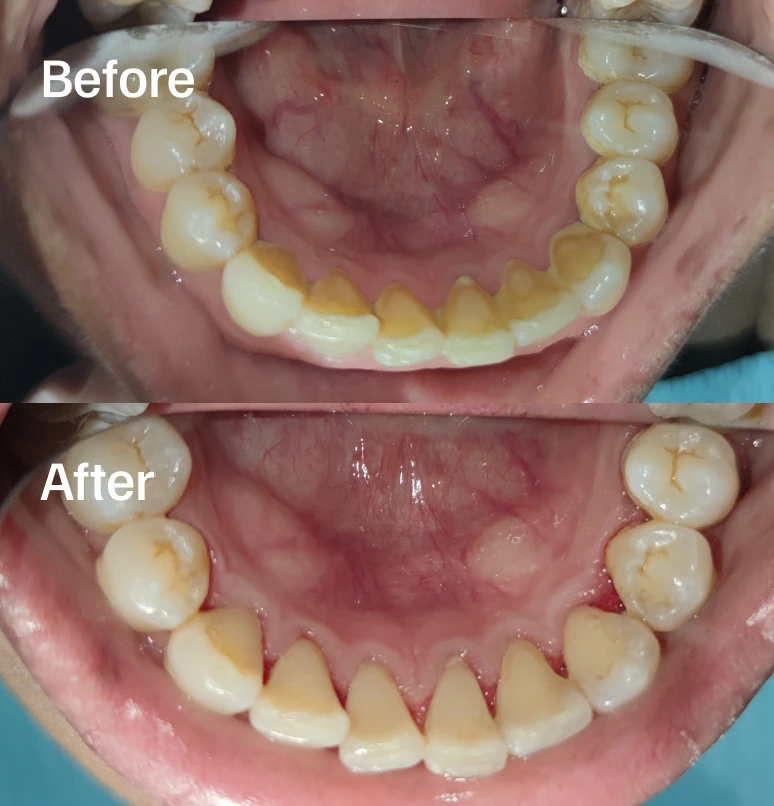 Focused deep cleaning to protect your lower teeth and gums.