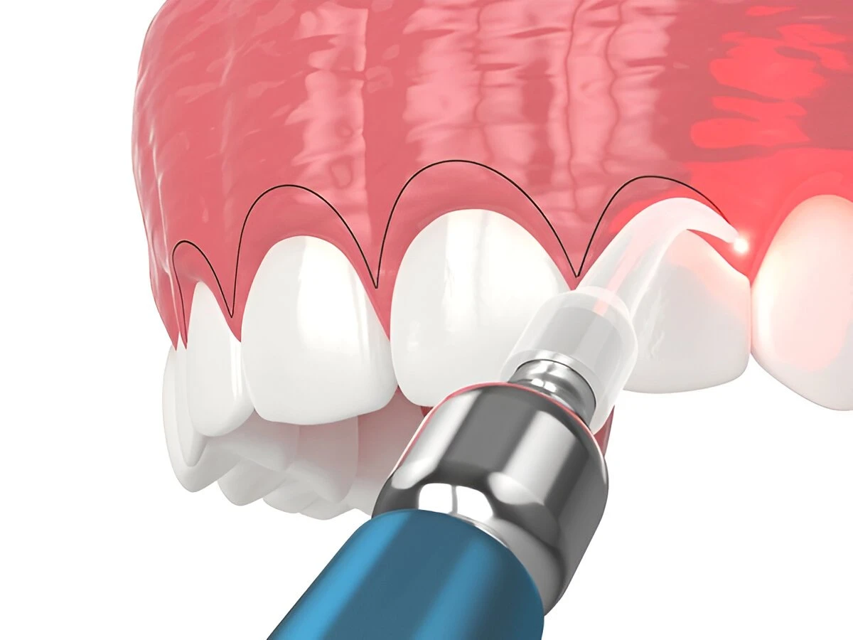 Gingivectomy
