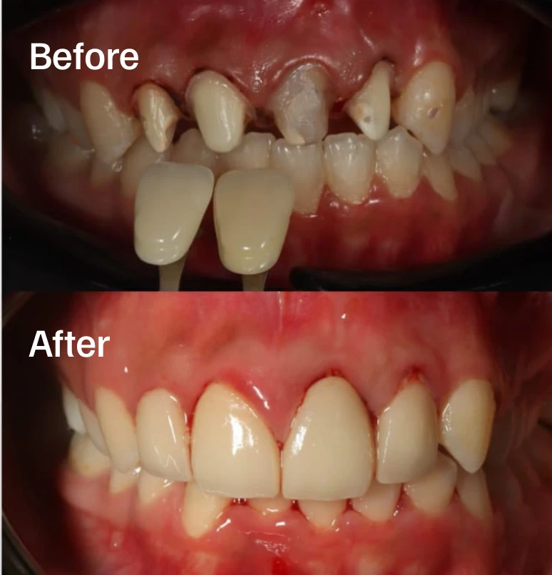 Strong, durable protection for a compromised tooth.