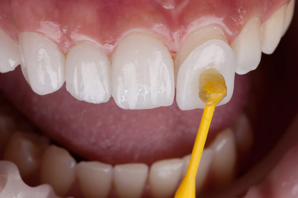 Veneer dan Crown